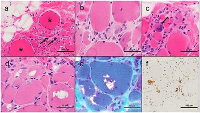 GNE Myopathy With Novel Mutations and Pronounced Paraspinal Muscle Atrophy